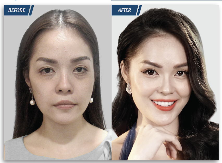 trẻ hóa làn da