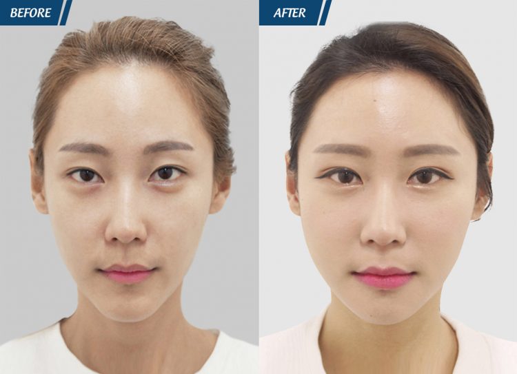 trước sau cấy mỡ mặt