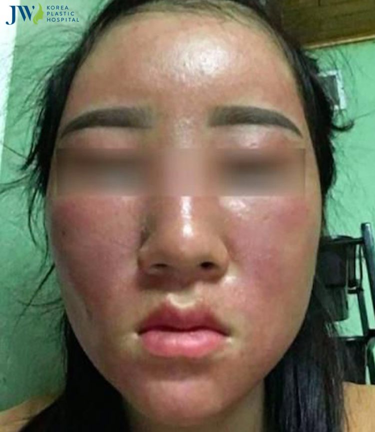 điều trị nám