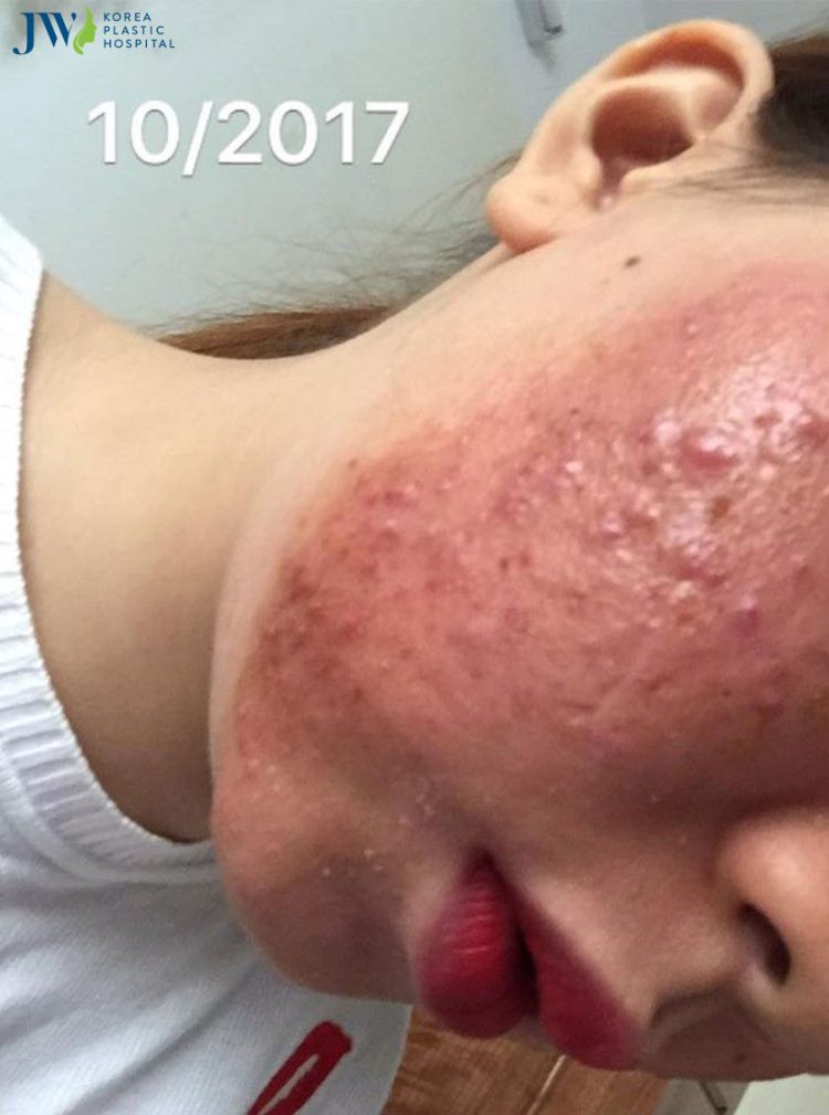 điều trị nám