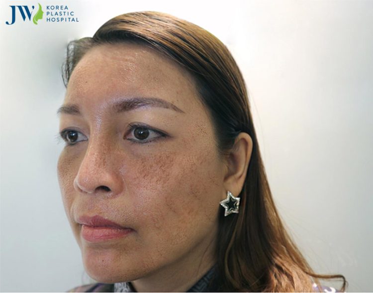điều trị nám