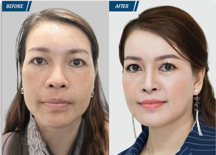 điều trị nám
