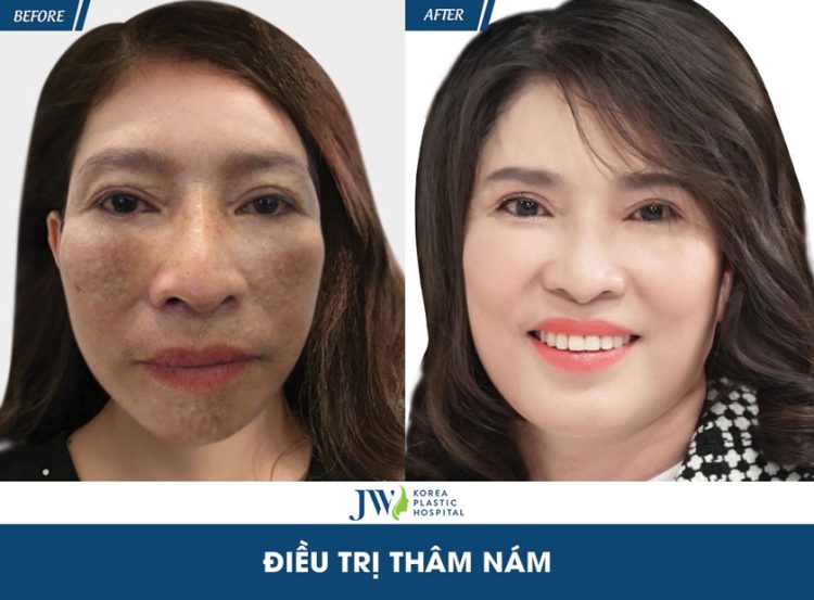 điều trị nám
