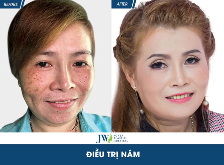 điều trị nám