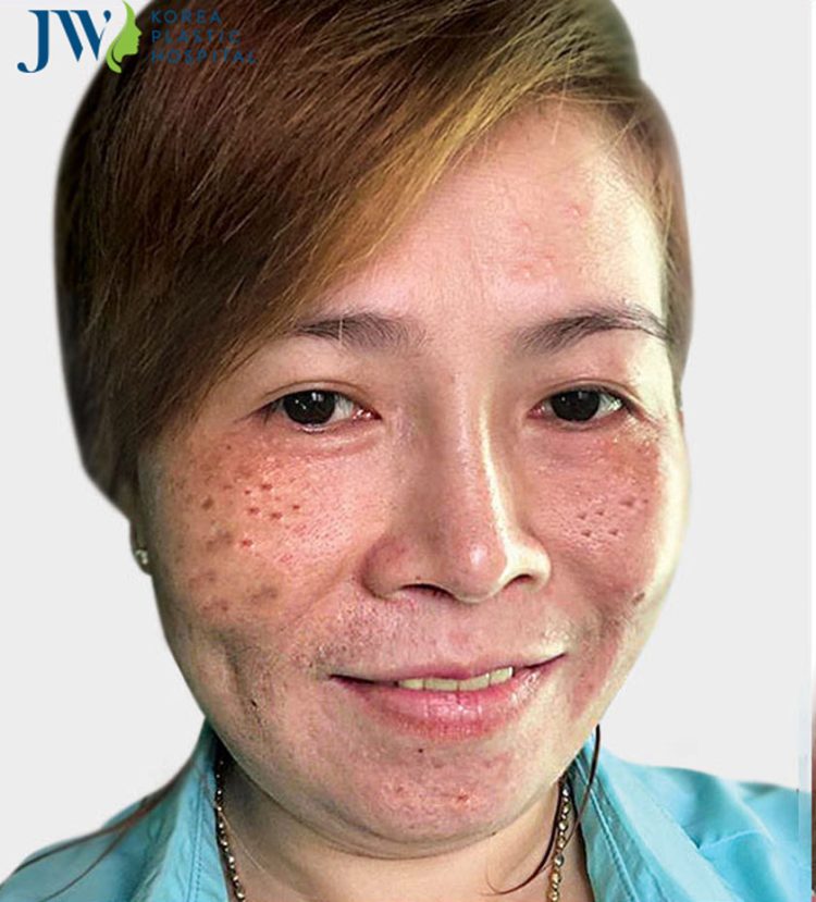 điều trị nám