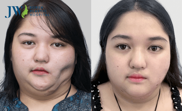 cải lão gương mặt 3m