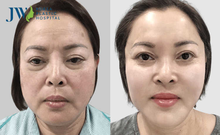 Cải lão gương mặt 3M