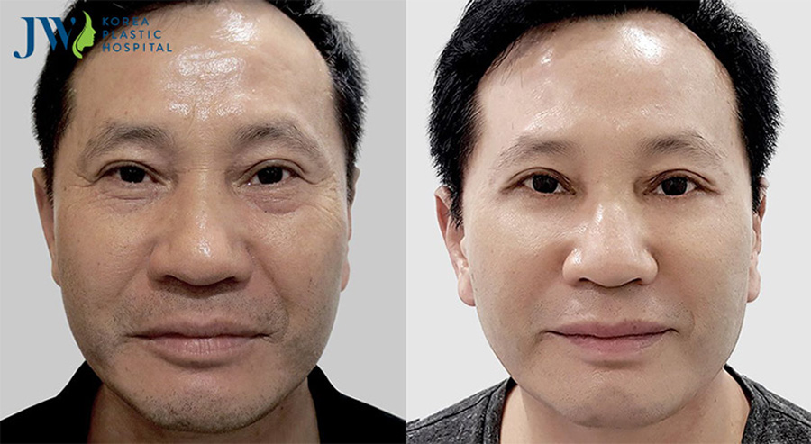 cải lão gương mặt có để lại sẹo hình