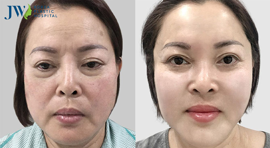cải lão gương mặt có để lại sẹo