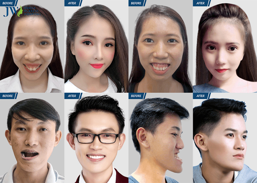 Phẫu thuật thẩm mỹ răng hàm mặt