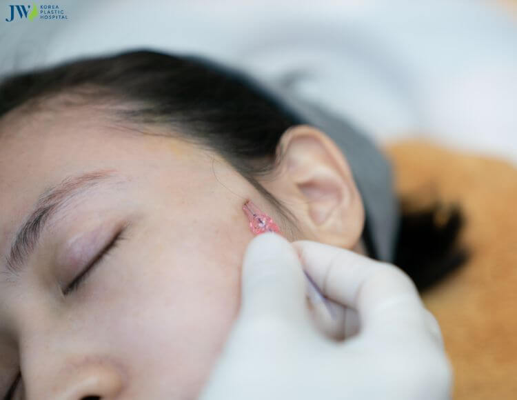 Căng chỉ nâng cơ - Liệu pháp trẻ hoá không cần phẫu thuật 2