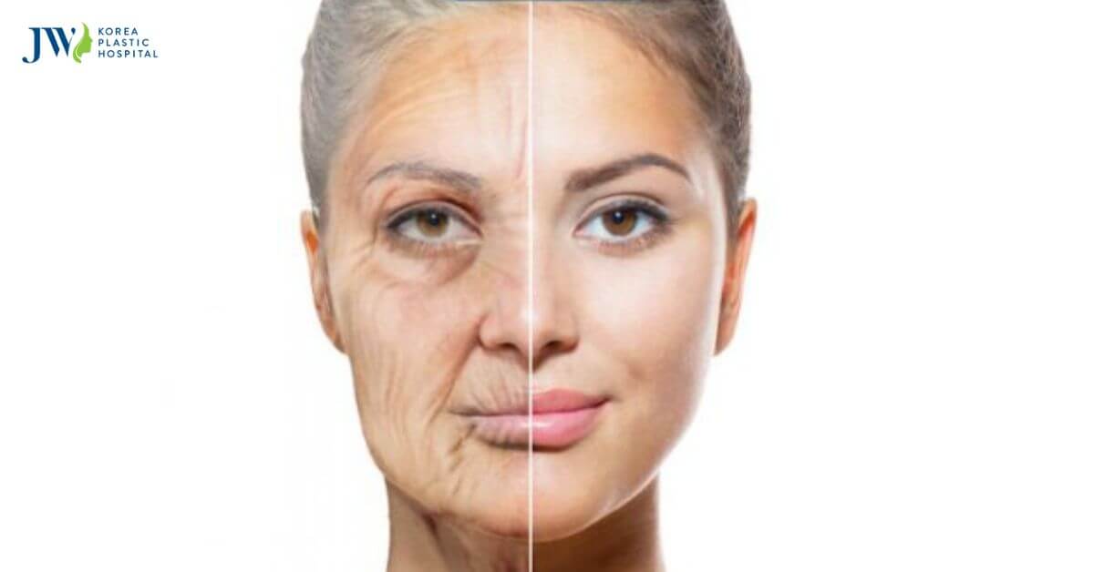 Căng da mặt