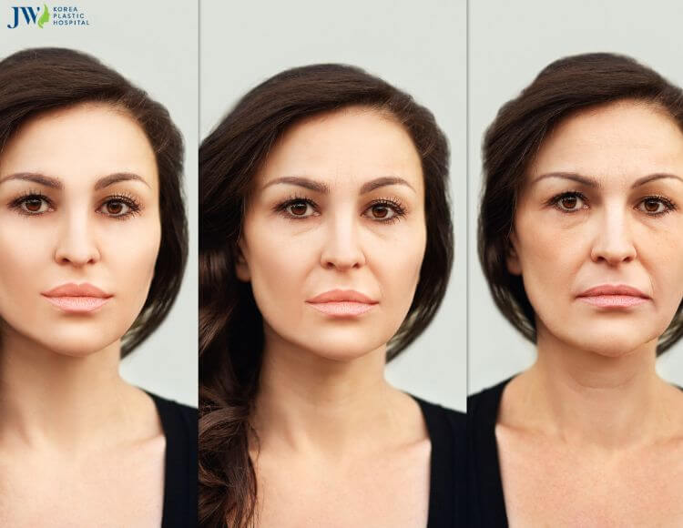 Nhược điểm của căng chỉ collagen 3