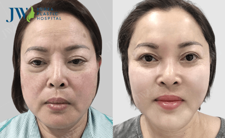 sau khi căng chỉ collagen