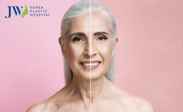 sau khi căng chỉ collagen