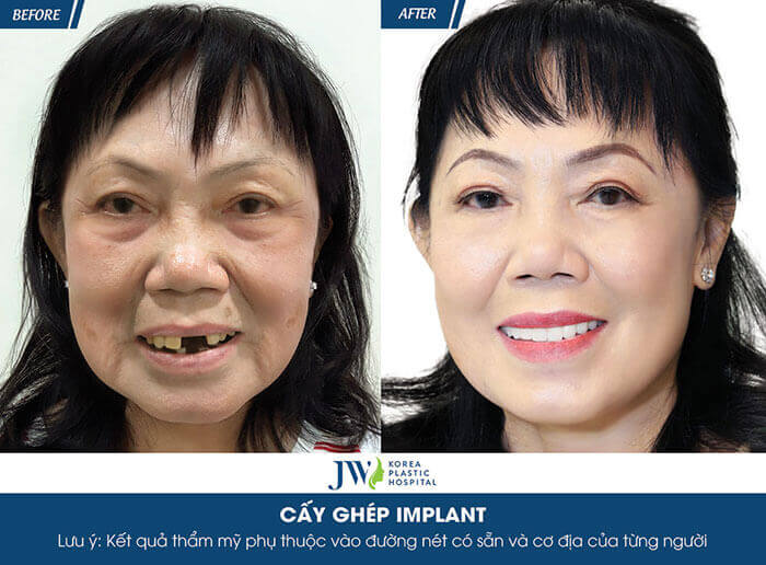 implant
