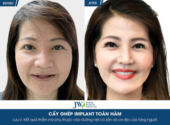 implant