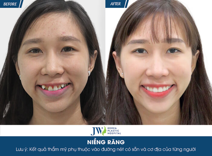 niềng răng