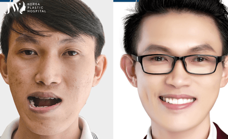 phau thuat ham mom