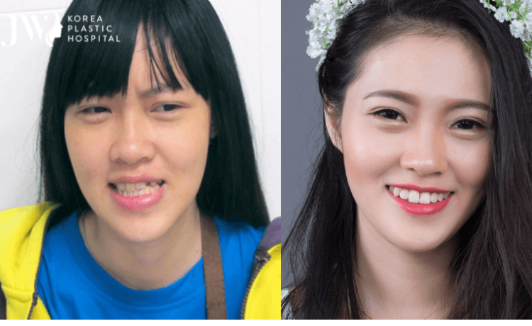 phau thuat ham mom bsso