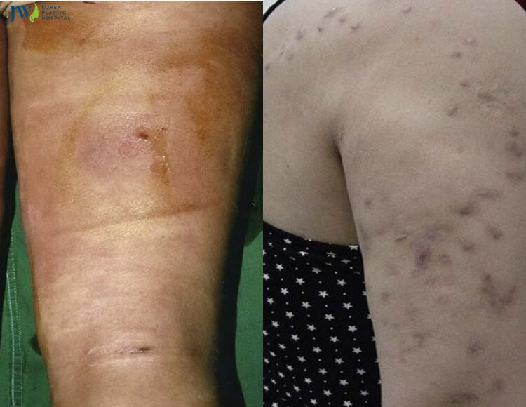 Quy trình chăm sóc bệnh nhân hút mỡ 5