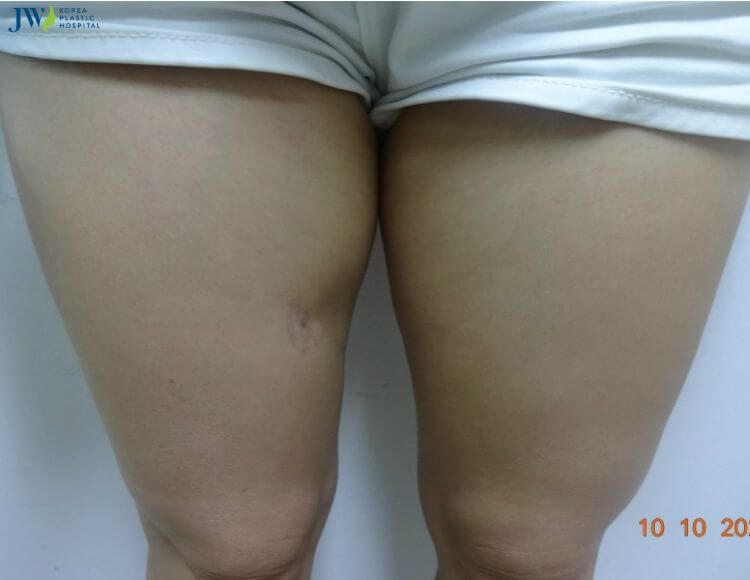 Quy trình chăm sóc bệnh nhân hút mỡ 6