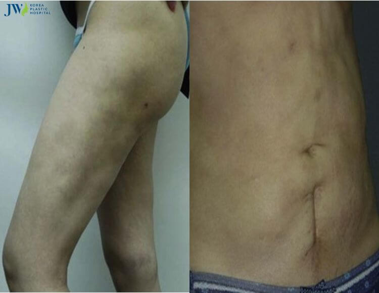 Quy trình chăm sóc bệnh nhân hút mỡ 7