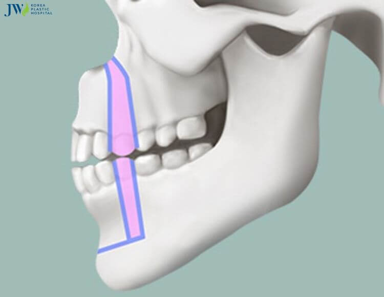 Quy trình chăm sóc bệnh nhân phẫu thuật hàm hô tiền đình hàm (ASO) 3