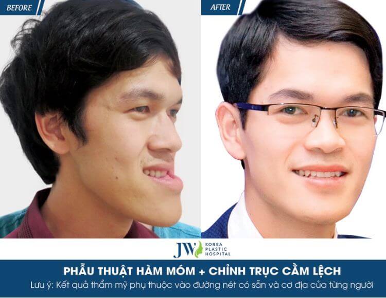 Quy trình chăm sóc bệnh nhân nhân Phẫu thuật Lefort I 1