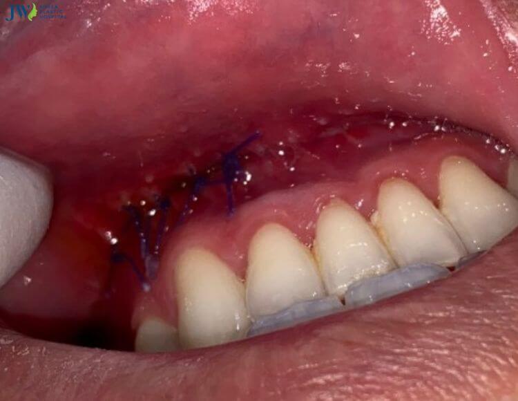 Quy trình chăm sóc bệnh nhân sau phẫu thuật chỉnh hình tiền đình xương hàm (ASO) 6