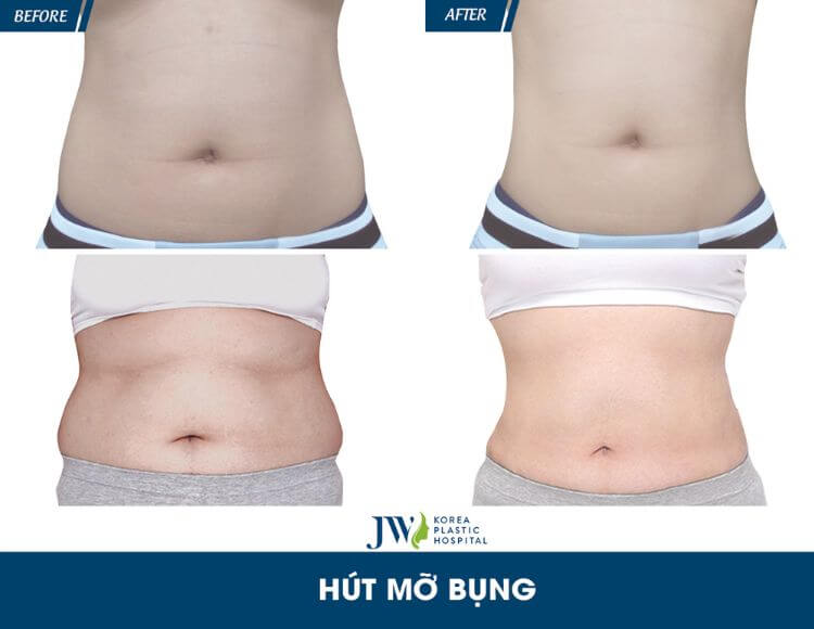 Quy trình chăm sóc bệnh nhân hút mỡ bụng toàn bộ