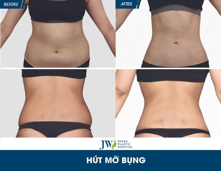 Quy trình chăm sóc bệnh nhân hút mỡ bụng toàn bộ