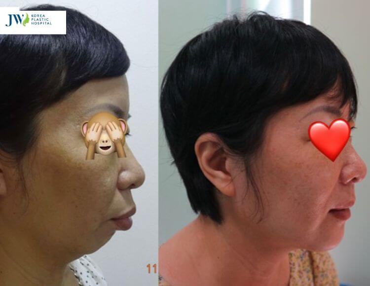 Quy trình chăm sóc bệnh nhân sau phẫu thuật tạo hình cằm (ASO) 1