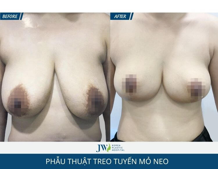 Quy trình chăm sóc sau phẫu thuật treo tuyến mỏ neo 3