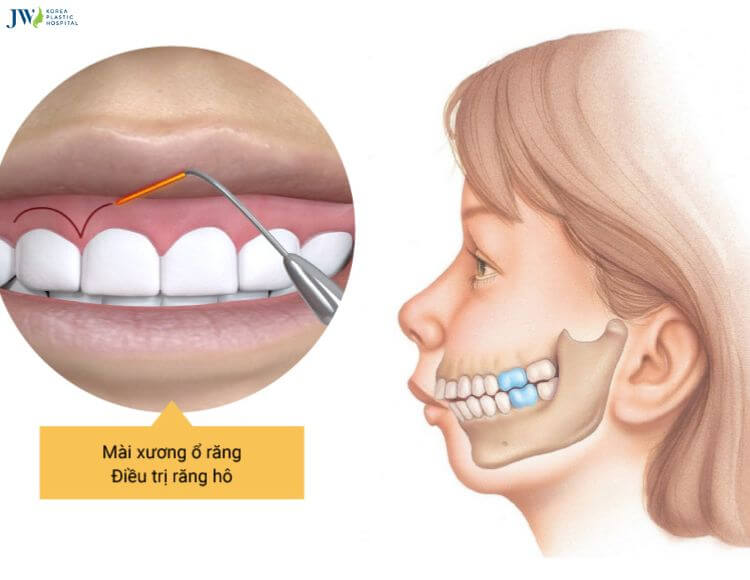 Bạn hiểu gì về hô xương ổ răng? 2