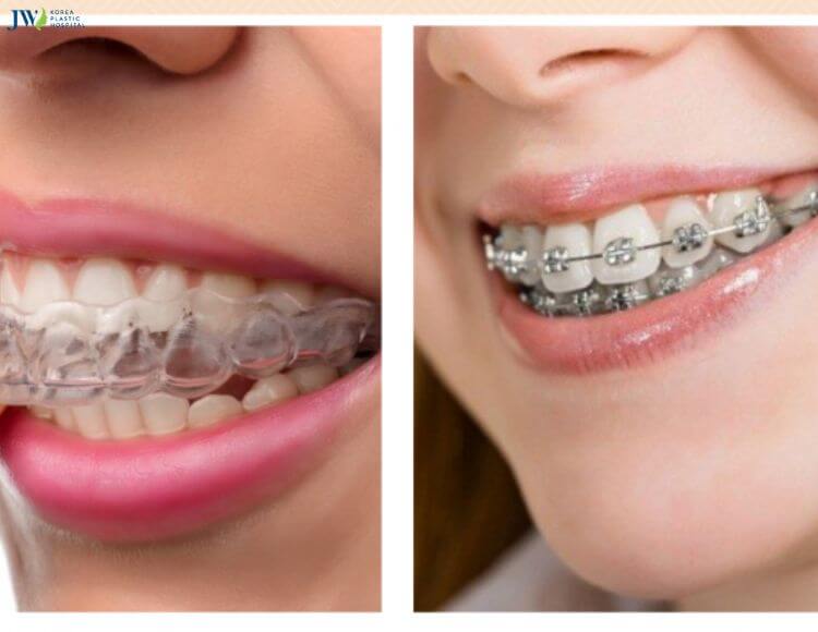 Bạn hiểu gì về hô xương ổ răng? 3
