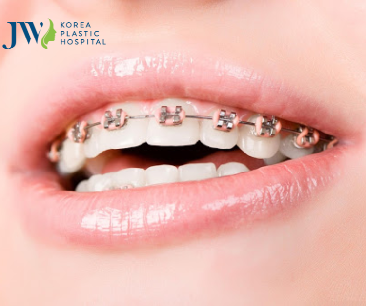 Các loại mắc cài niềng răng mang lại hiệu quả ngày nay