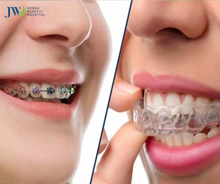 chi phí niềng răng trong suốt AI