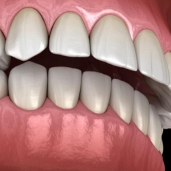 Quy trình niềng răng khớp cắn sâu