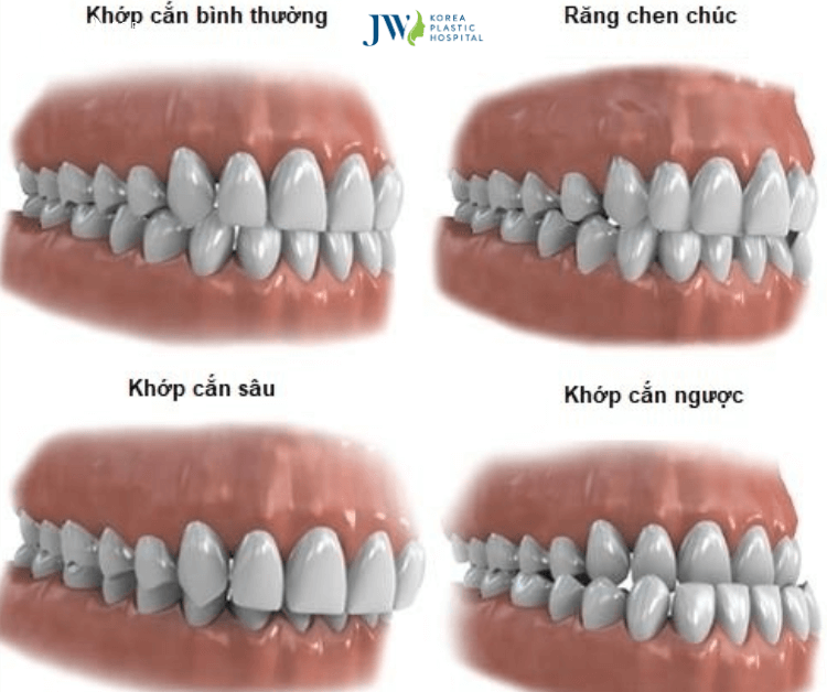 niềng răng khớp cắn sâu