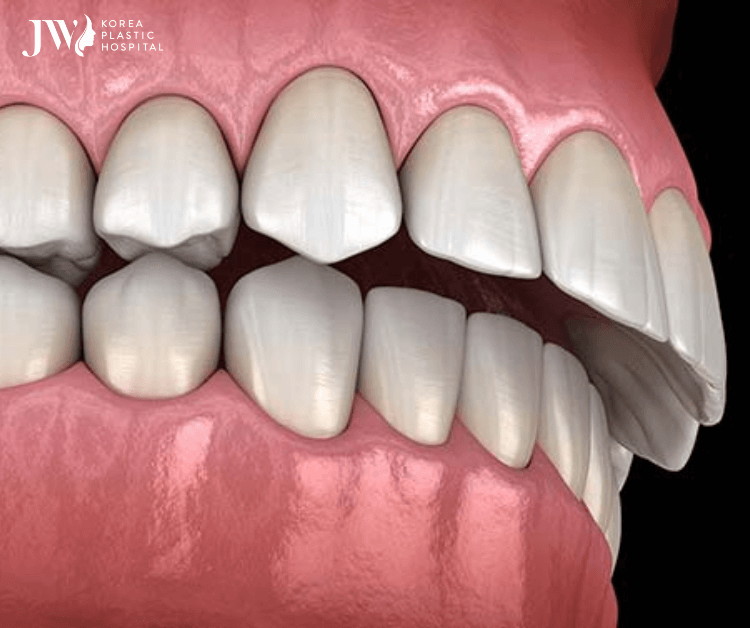 niềng răng khớp cắn sâu