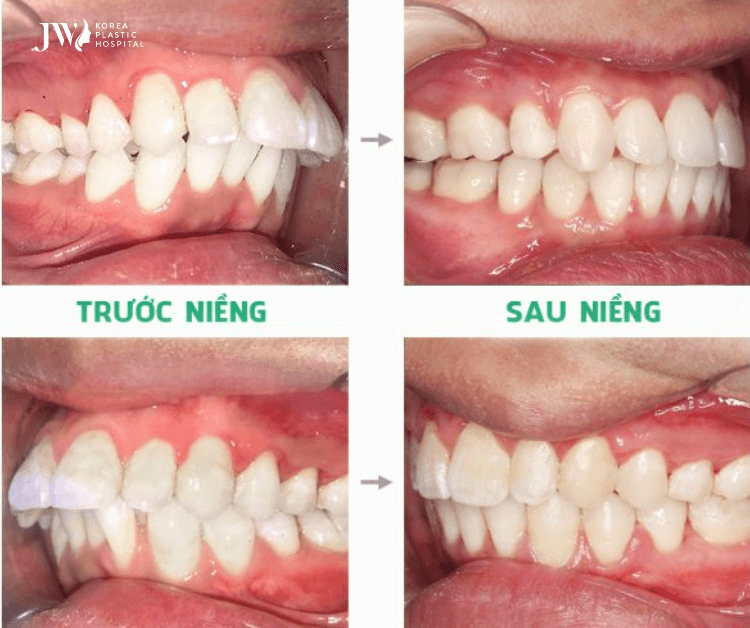 niềng răng khớp cắn sâu
