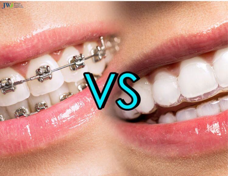 Niềng răng trong suốt AI có cần nhổ răng không? 1