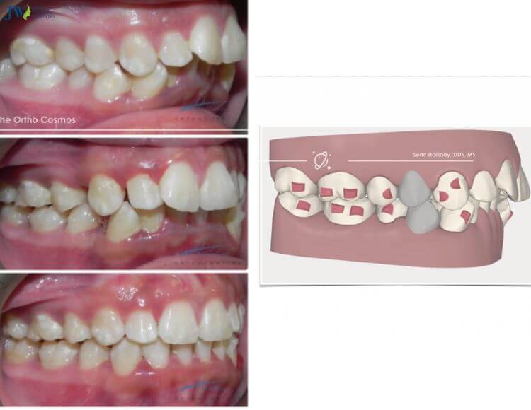 Niềng răng trong suốt AI có cần nhổ răng không? 3