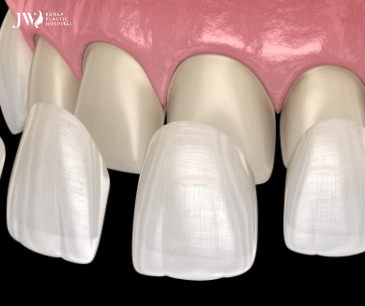 Răng sứ Veneer AI