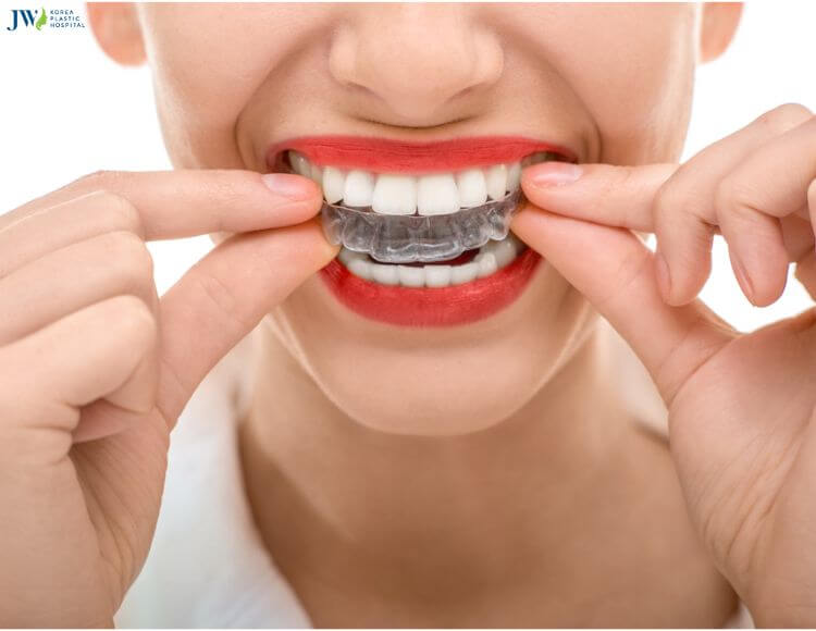 Thế nào là niềng răng trong suốt AI? 1