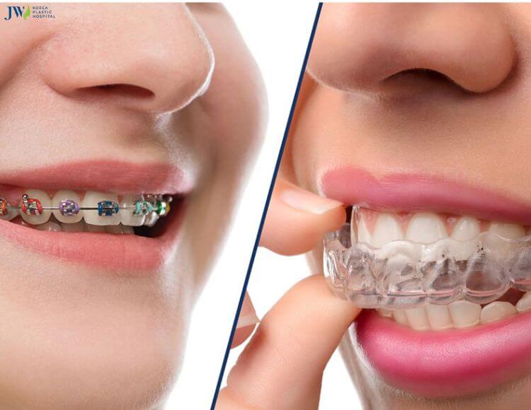 Thế nào là niềng răng trong suốt AI? 3
