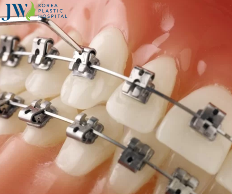Các loại mắc cài niềng răng mang lại hiệu quả ngày nay