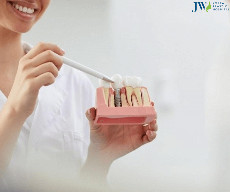 Công nghệ trồng răng Implant AI