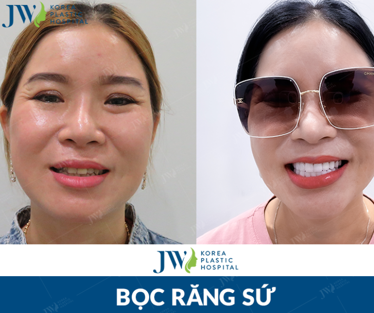 Nên lựa chọn niềng răng hay bọc sứ?